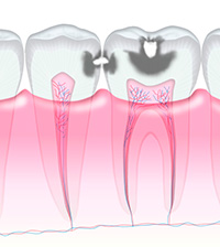 冷たいものがしみる