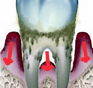 歯がグラグラする