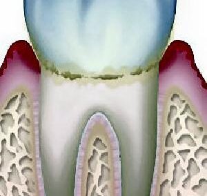 歯肉から出血する