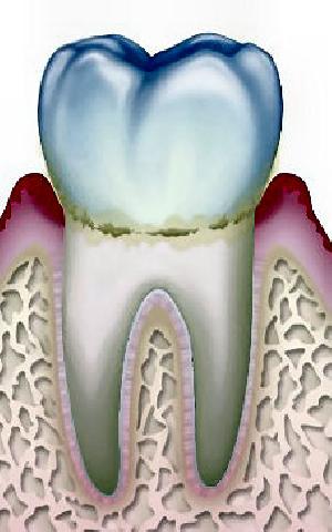 歯肉から出血する
