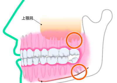 親知らずが痛む