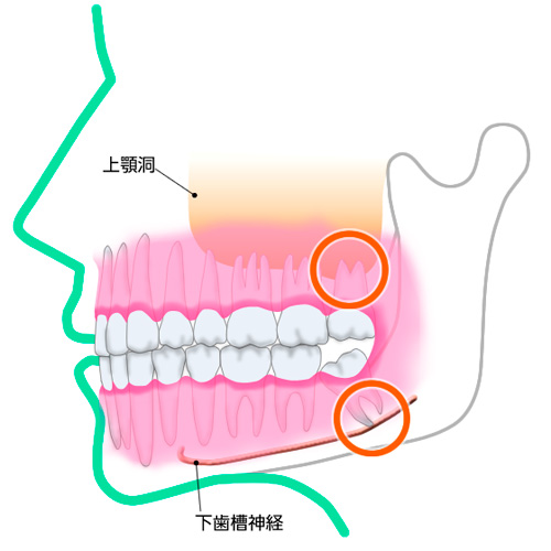 親知らずが痛む