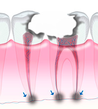 根の先あたりから膿が出る