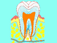 神経を抜くと歯はどうなる？
