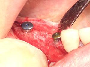 野坂歯科医院　インプラント埋込手術