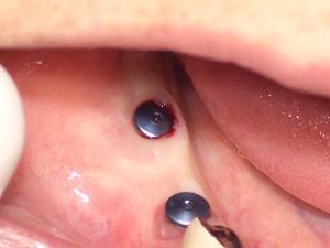 野坂歯科医院 インプラント治療期間