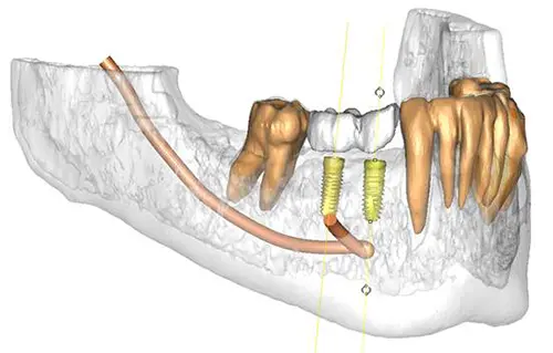 野坂歯科医院 インプラントの施術前に