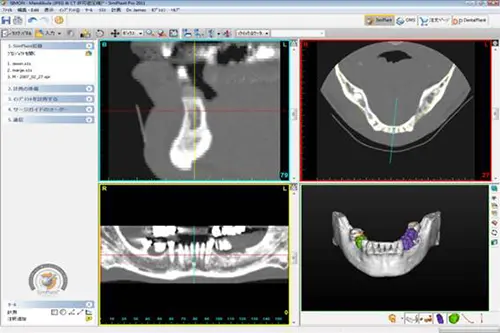 野坂歯科医院 インプラントの検査