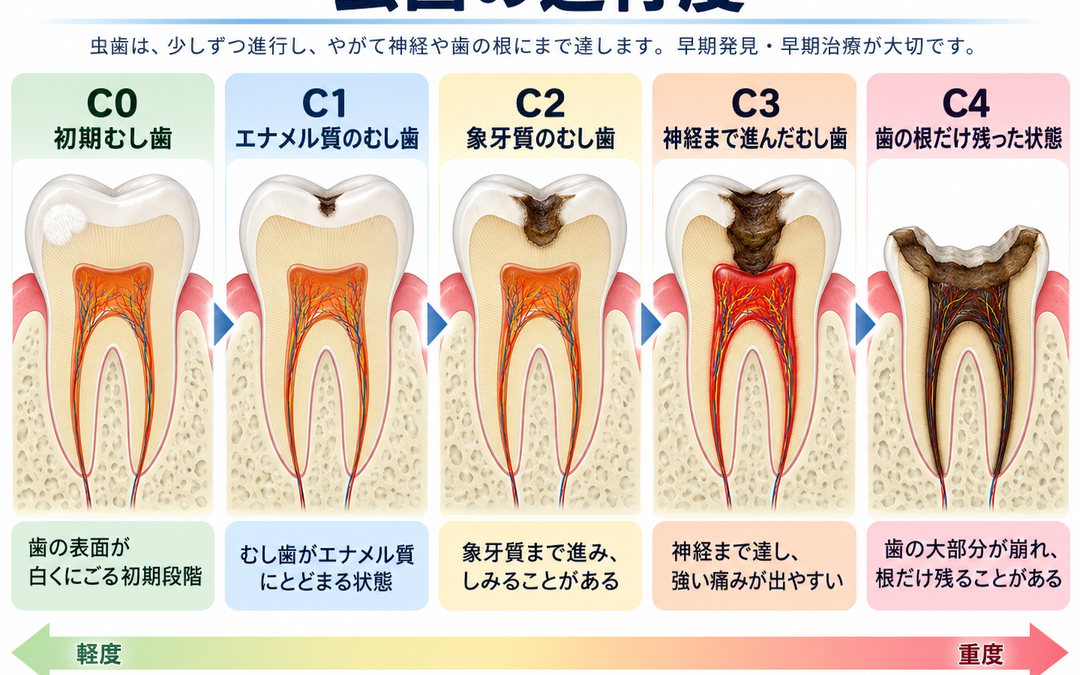 むし歯治療　
